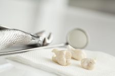 Extractions and wisdom teeth
