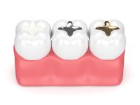3d render of teeth with gold, amalgam and composite inlay dental filling over white background