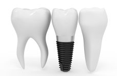 Implants