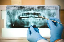 Root canal therapy