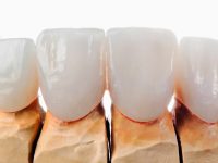 Dental micro veneer. Selective focus.You can find more dental related images like this one here :